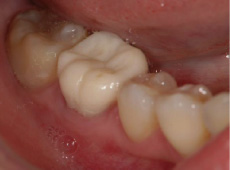 オールセラミックの治療例＿仮歯