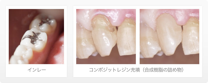 う蝕（虫歯）から歯髄（歯の神経）を保護する（C1～C2の治療法）