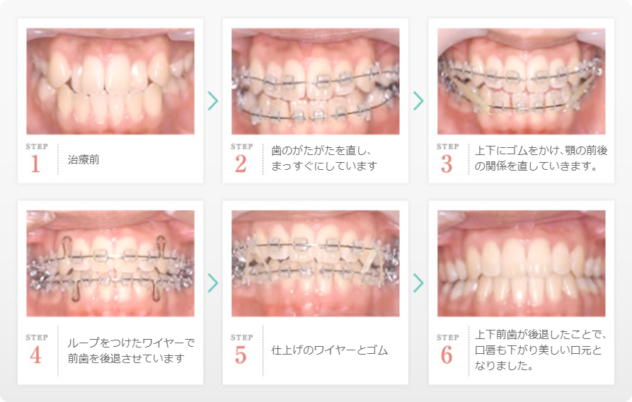 治療前後の歯並びの改善