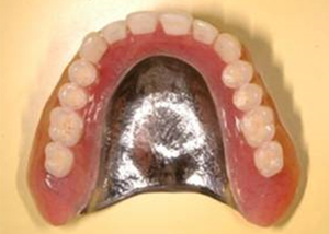 金属床総義歯（保険適用外）の一例
