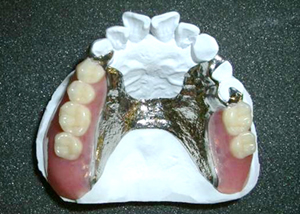 金属床部分床義歯（保険適用外）の一例