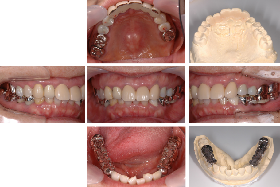 上顎前歯のレジンプレート下顎奥歯のメタルプレートによる経過観察