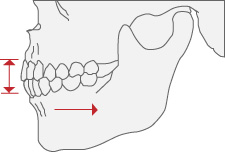 かみ合わせのずれは、下顎の位置を移動（偏位）させ、