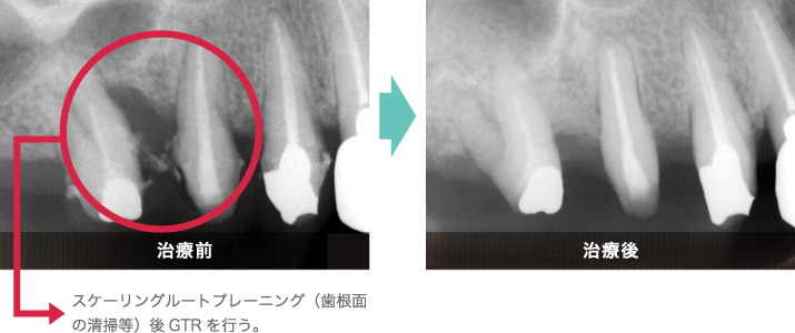 歯周組織再生誘導法の治療前後の比較